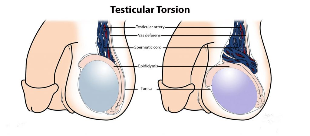 پیچ خوردگی بیضه