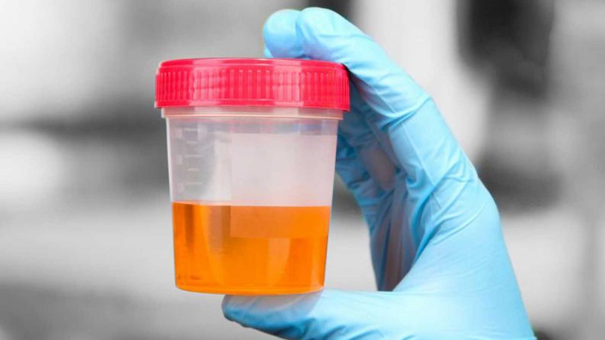 ادرار تیره به چه معنی است؟