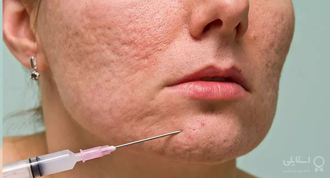 درمان اسکار گود شده: راه‌هایی برای کم کردن ظاهر آن