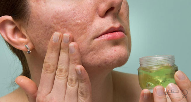 آیا هیچ روش درمانی طبیعی برای درمان اسکار گود شده وجود دارد؟