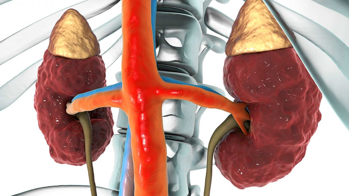 انواع بیماری کلیه ، علائم و درمان