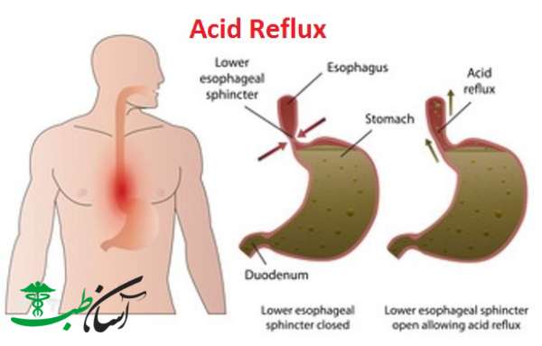 رفلاکس معده در طب سنتی