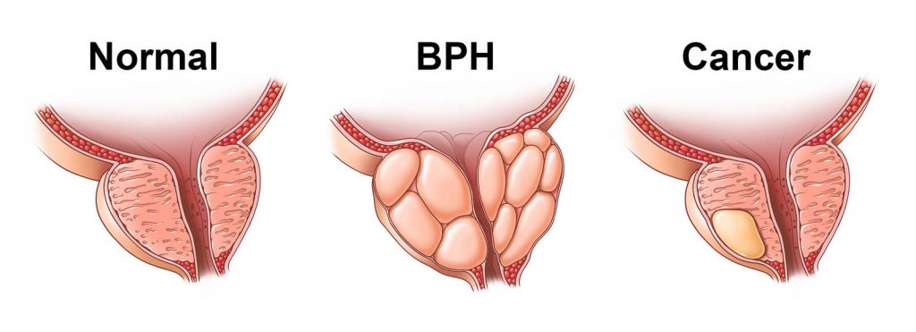 بزرگی پروستات یا bph