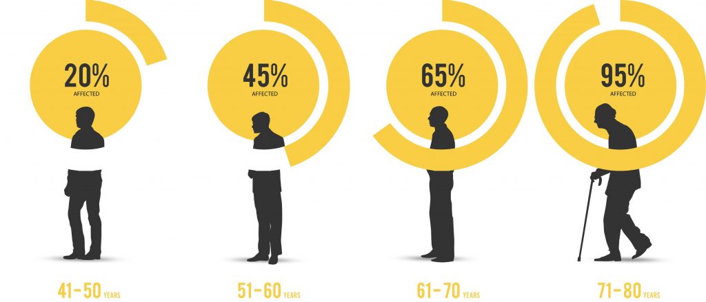 سن ابتلا به بزرگی پروستات