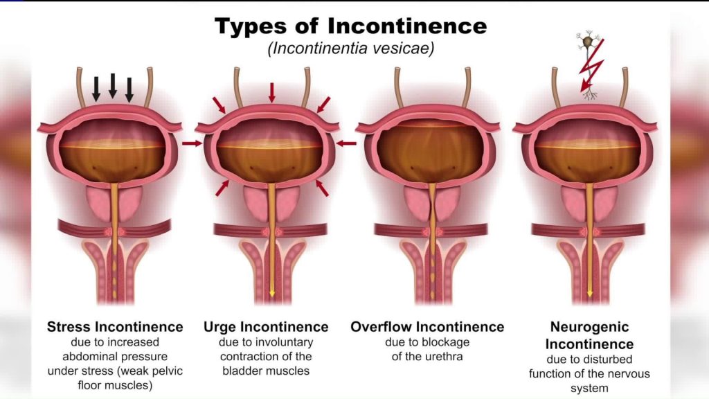 انواع بی اختیاری ادرار