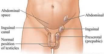 بیضه نزول نکرده