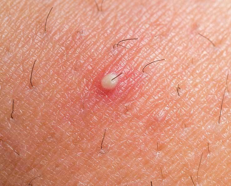 رشد مو درون جوش