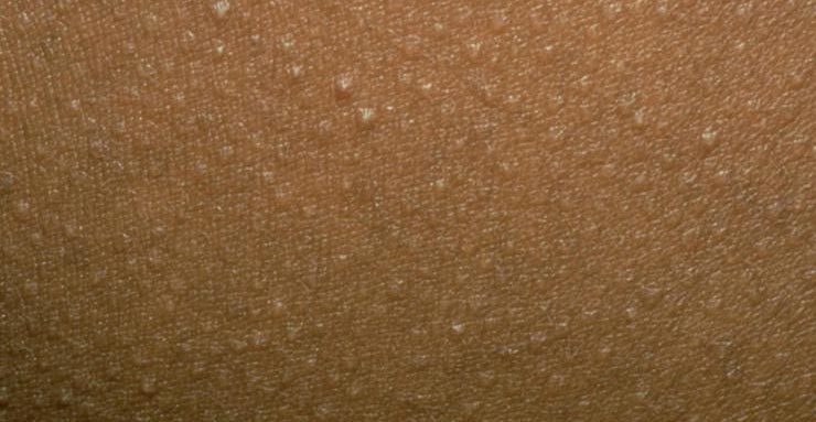 کراتوز پیلاریس