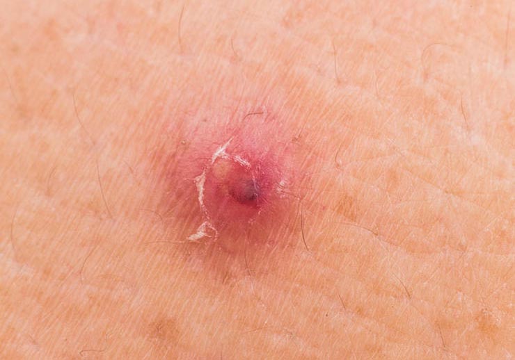 آکنه کیستیک