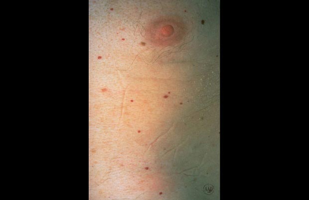 خال‌های عروقی به رنگ گیلاس