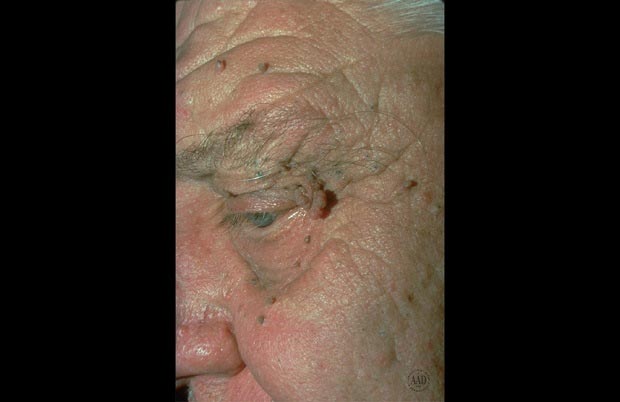 منگوله‌های پوستی