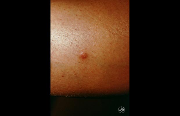 فیبروم پوستی