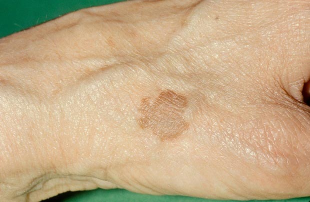 لکه های خورشیدی