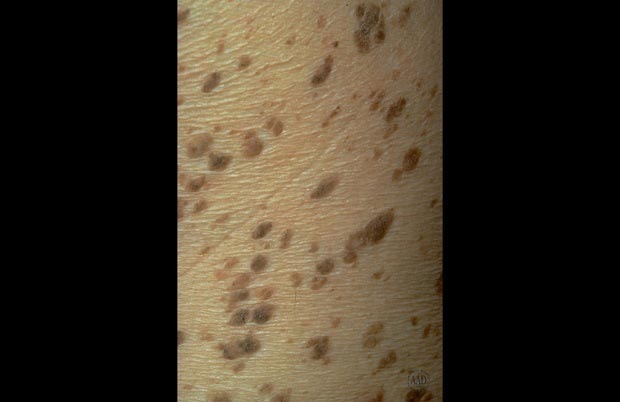 چربی شاخی پوستی