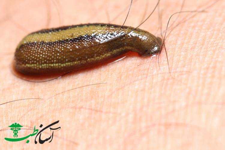 زالو درمانی در طب سنتی