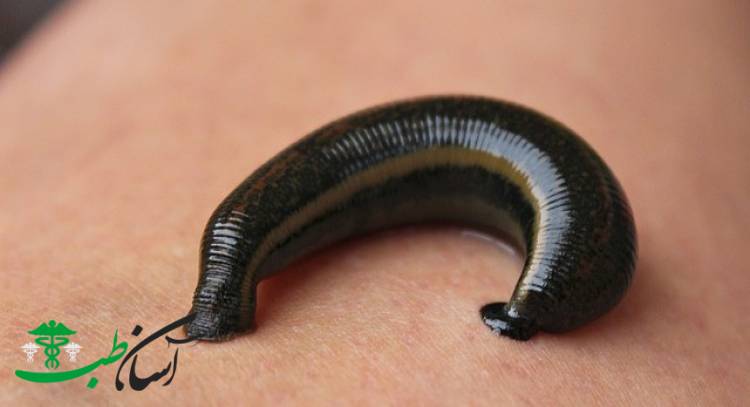 زالو درمانی