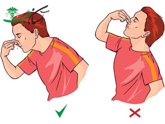 بند آوردن خون دماغ