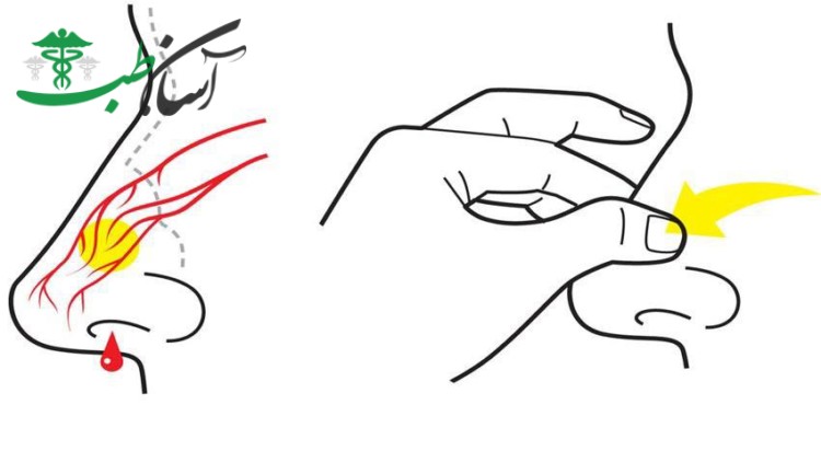 درمان خون دماغ