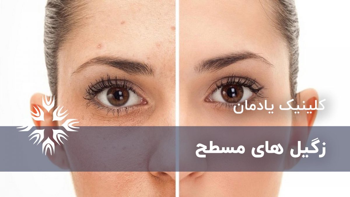 زگیل های مسطح