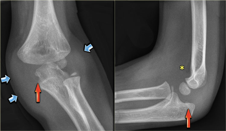 ام آر آی شکستگی آرنج