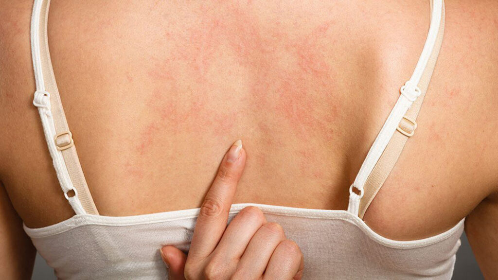 درماتیت تماسی تحریکی