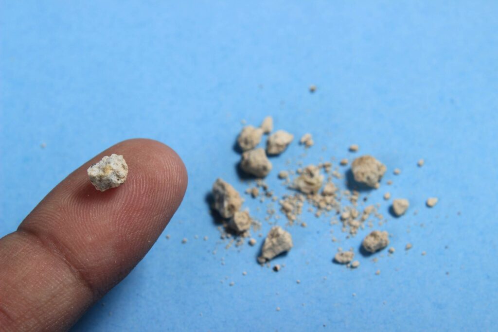 سنگ کلیه از عوارض نگه داشتن ادرار