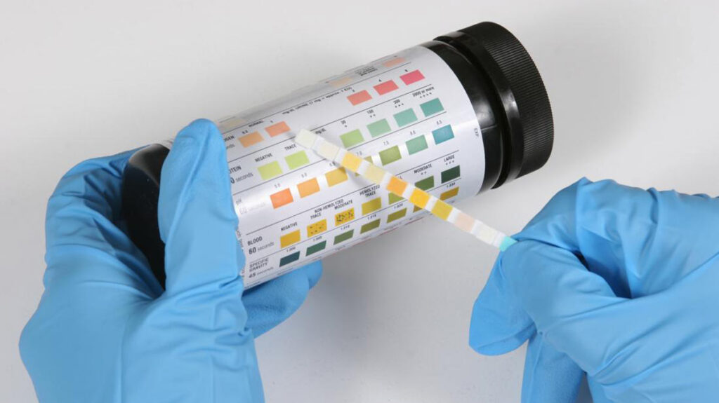 درمان لکوسیت در ادرار