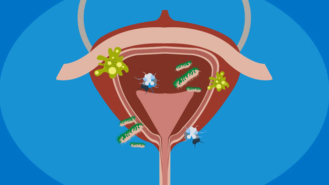پیشگیری عفونت ادراری
