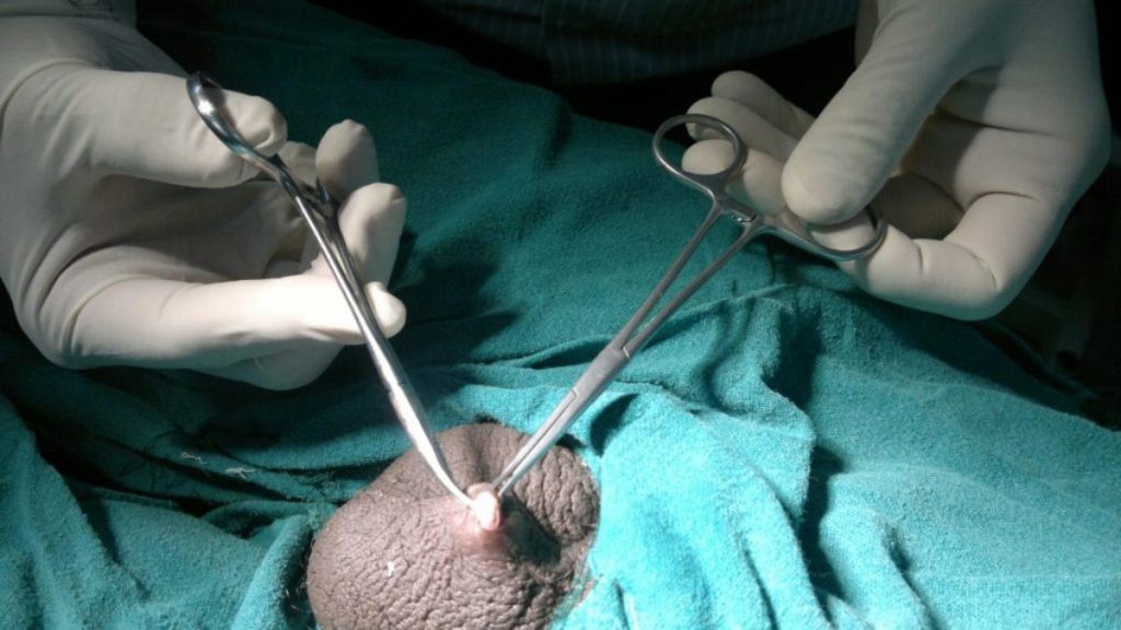 وازکتومی بدون تیغ جراحی