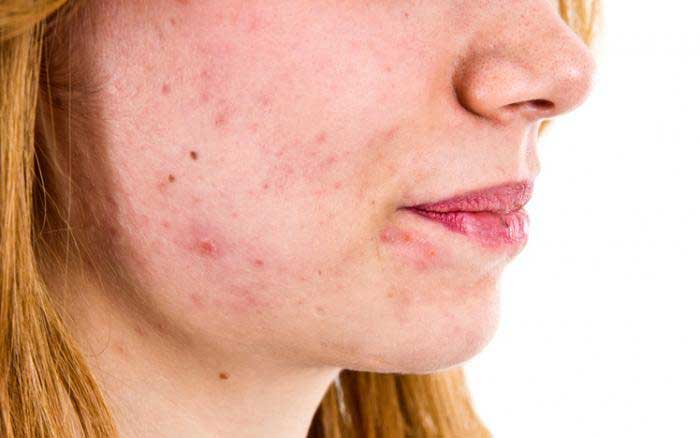 خواص ویتامین b5 برای درمان آکنه