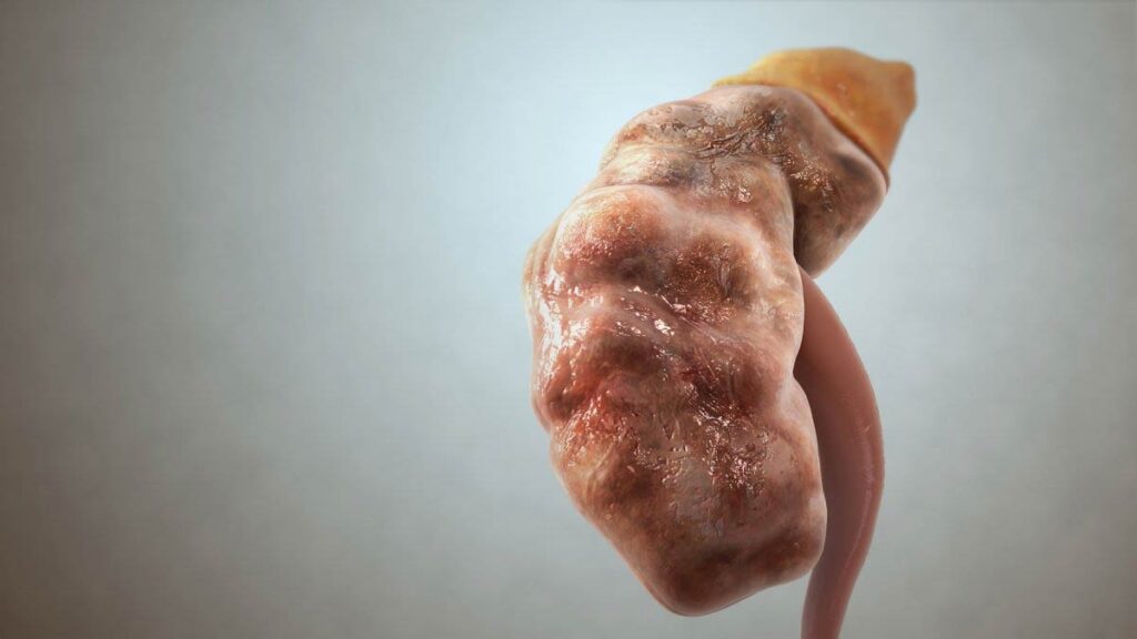 آسیب کلیه در اثر ویروس کرونا