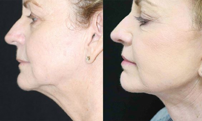 چاقی صورت و خواب