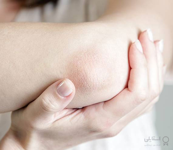 چگونه ترک‌های پوستی پا، دست و آرنج را برطرف کنیم