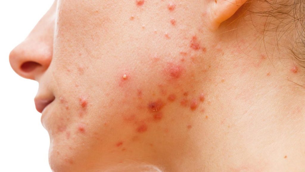 زگیل های تناسلی چگونه پخش می شوند؟