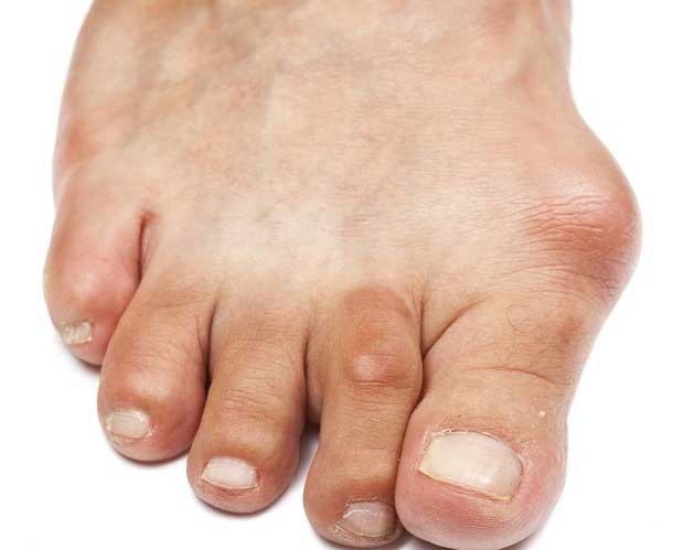 انحراف شست و انگشت چکشی پا