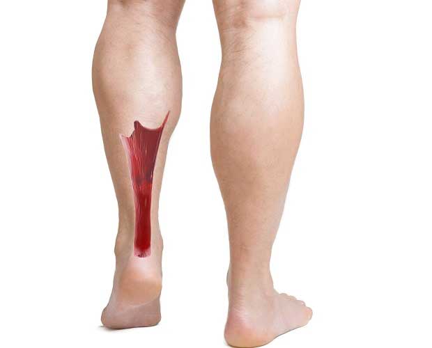 التهاب تاندون آشیل