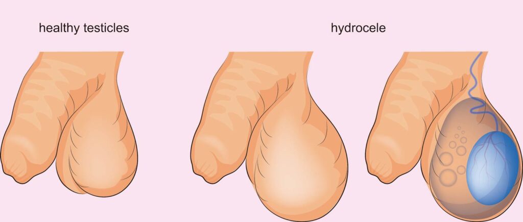 هیدروسل یا آب آوردن بیضه