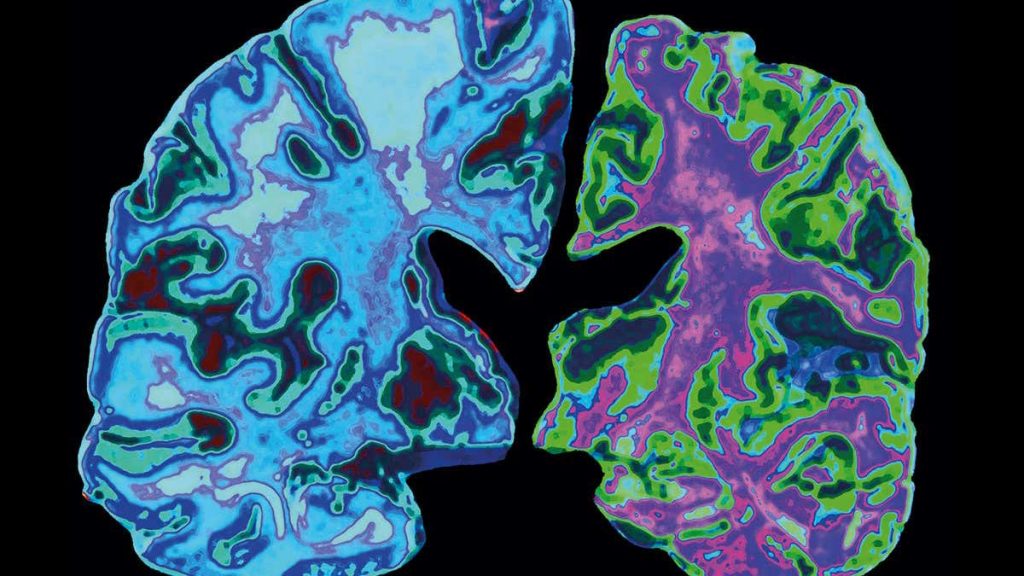 زوال عقل، آلزایمر