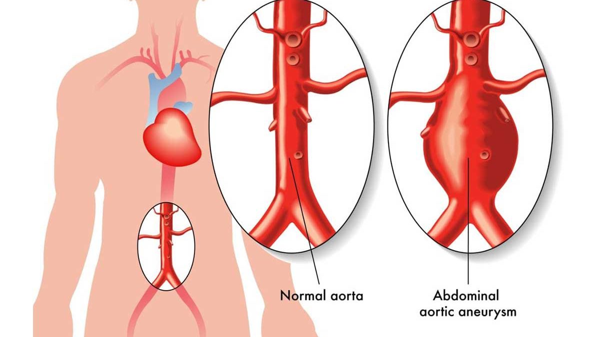 آنوریسم آئورت شکمی | جلوگیری از خونریزی داخلی