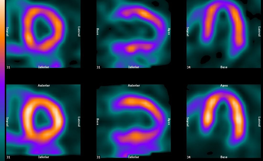 اسکن هسته ای قلب |  اسکن تالیوم