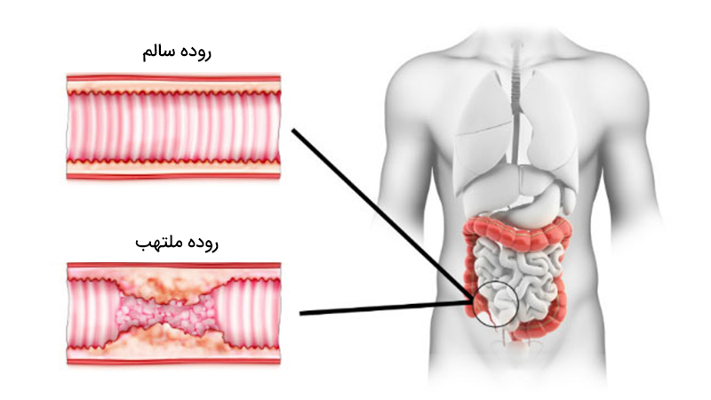 تشخیص بیماری کرون