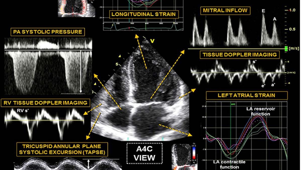 اکوکاردیوگرافی بافت داپلر و موارد استفاده از آن
