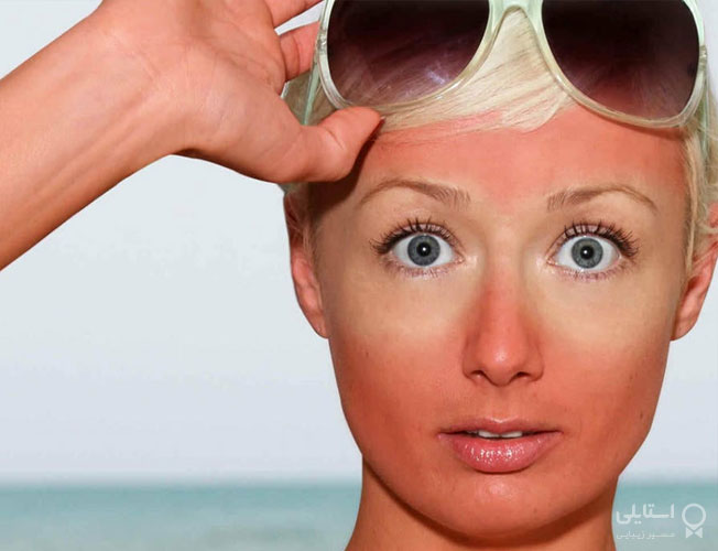 آفتاب سوختگی