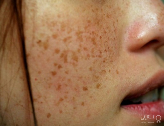 لکه‌های پیری ناشی از آفتاب