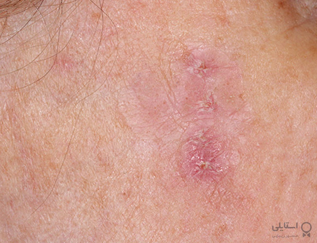 شاخی شدن پوست ناشی از آفتاب