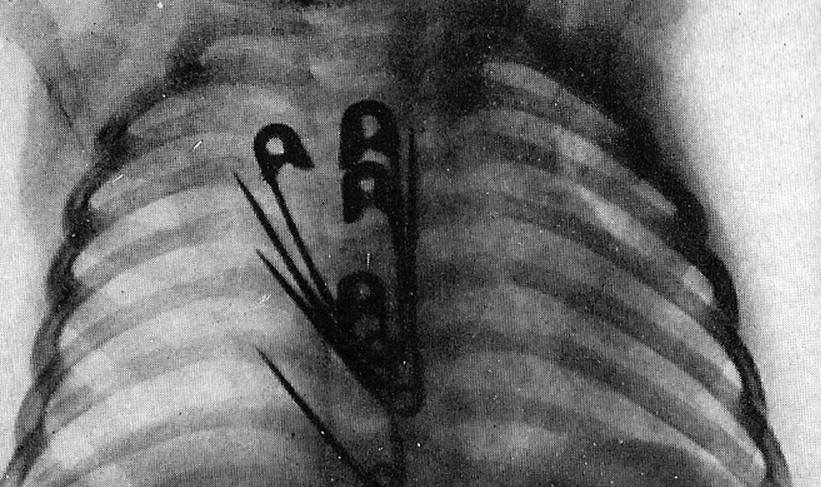 تشخیص جسم خارجی بلعیده شده