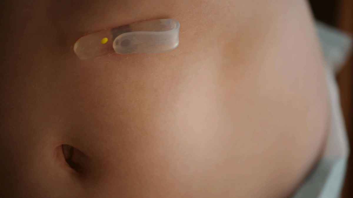 تعبیه لوله تغذیه (گاستروستومی)