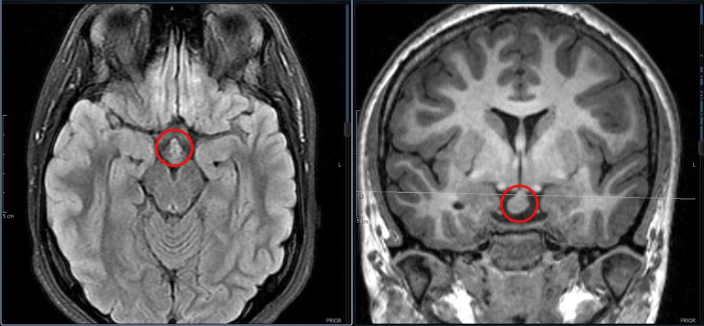 تشخیص تومور مغزی