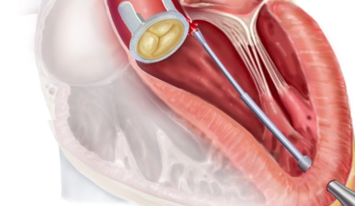 دریچه های قلبی مصنوعی | انواع دریچه های مصنوعی