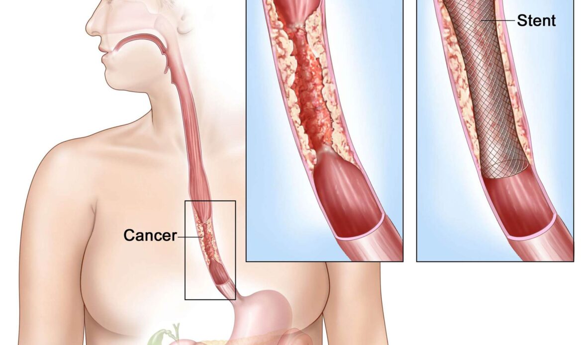 وارد کردن استنت